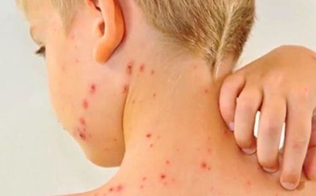 الحصبة تجتاح خُمس الولايات الأميركية والحالات تناهز الـ 900