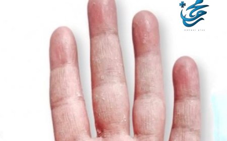 لماذا يتقشر جلد أصابعك؟ أسباب وحلول فعّالة لحماية يديك