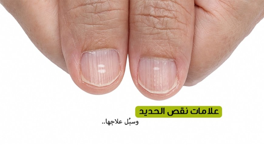 نقص الحديد.. العدو الخفي لصحة المرأة وجمالها