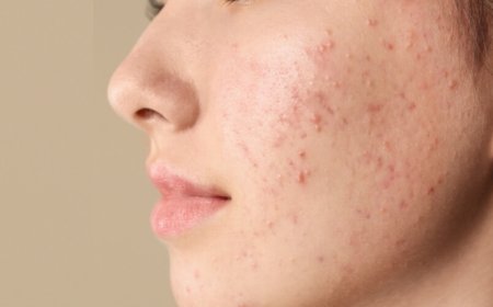 حب الشباب.. مشكلة شائعة وحلول متعددة بين الطب والطبيعة