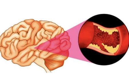الجلطة الدماغية.. كيف تنقذ حياة شخص في دقائق؟