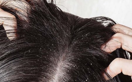 هل يمكن علاج قشرة الشعر بسرعة؟