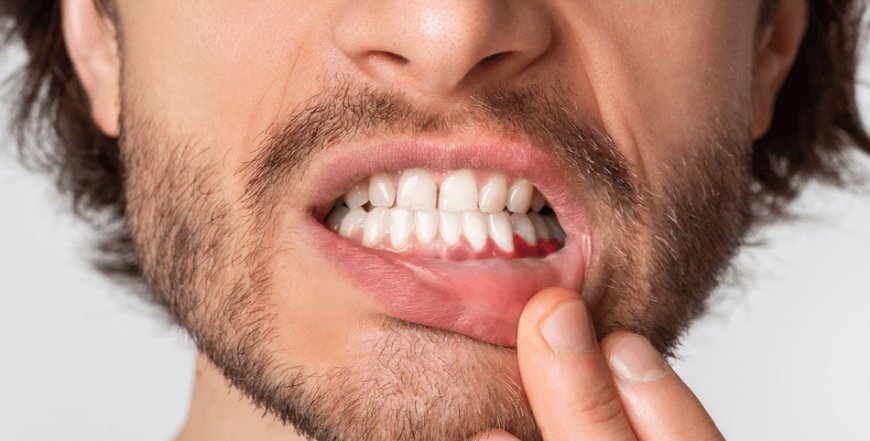 إلتهاب اللثة.. خطر صامت قد يصل إلى القلب