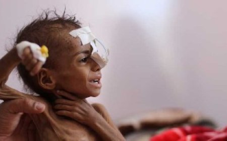 تقرير أممي: 18.1 مليون يمني على حافة الجوع و41 ألفًا مهددون بالمجاعة