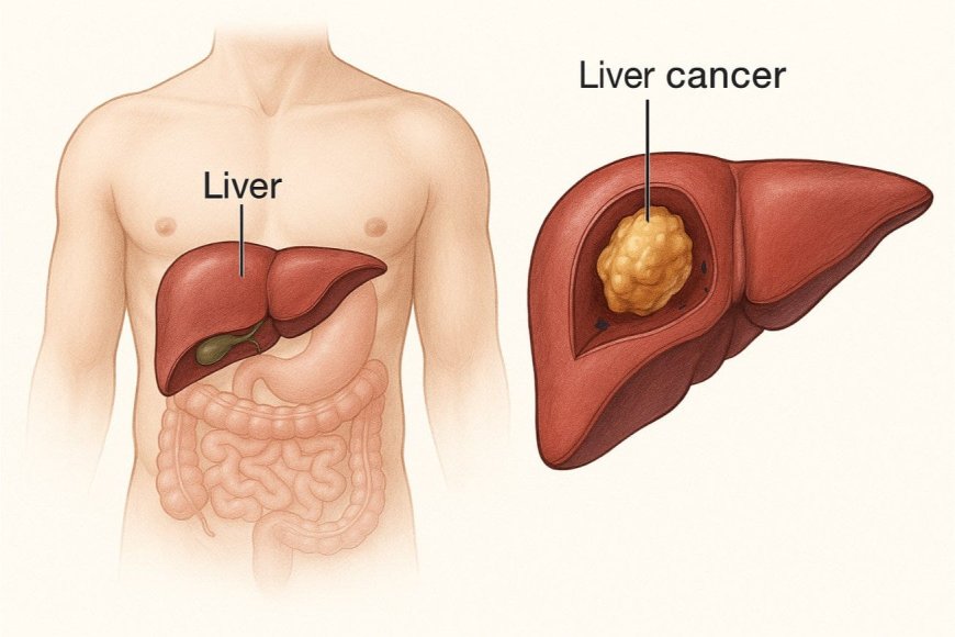 تضخم الكبد… علامة صامتة لمرض خطير يحتاج إلى انتباه مبكر
