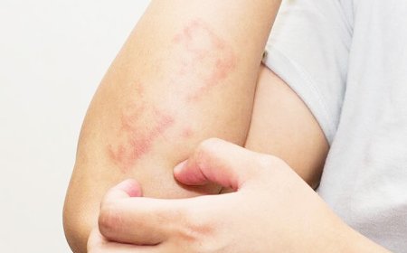 الحزاز المتصلب… مرض جلدي صامت قد يُهدد جودة الحياة إذا أُهمل