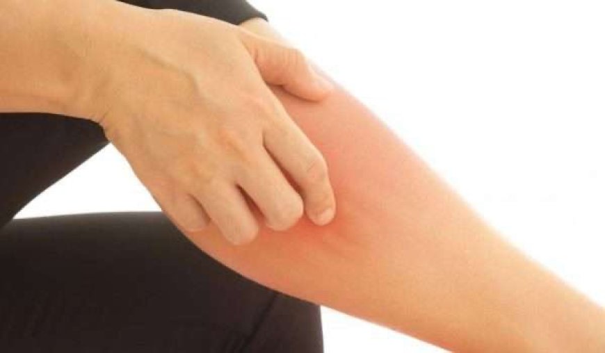 التهاب النسيج الخلوي.. عدوى جلدية شائعة قد تتحول إلى خطر يهدد الحياة إذا أُهملت