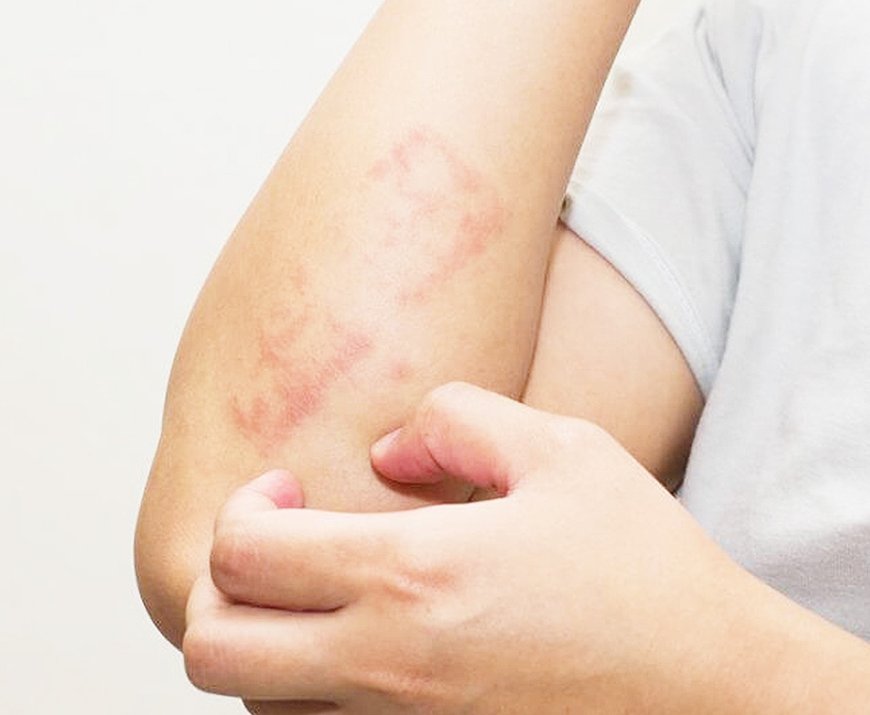 الحزاز المتصلب… مرض جلدي صامت قد يُهدد جودة الحياة إذا أُهمل