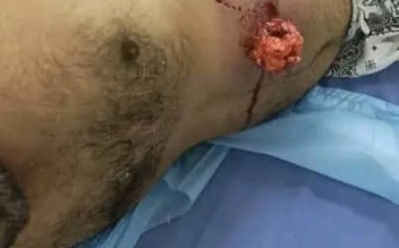 عاجل : وصول جرحى من المتظاهرين السلميين أمام بوابة معاشيق الى مستشفى عبود العسكري