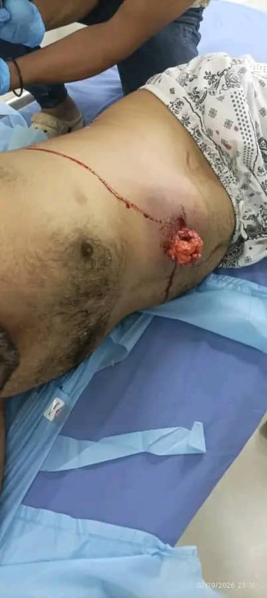 عاجل : وصول جرحى من المتظاهرين السلميين أمام بوابة معاشيق الى مستشفى عبود العسكري